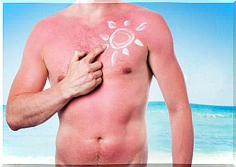 sunburns are harmful effects of the sun on the skin