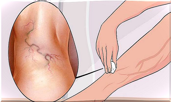 treat varicose veins