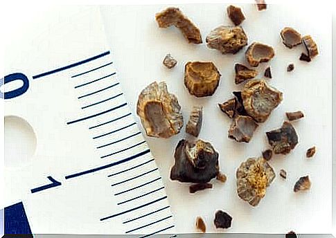 Different sizes of kidney stones.