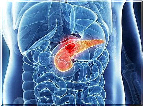 pancreatic cancer