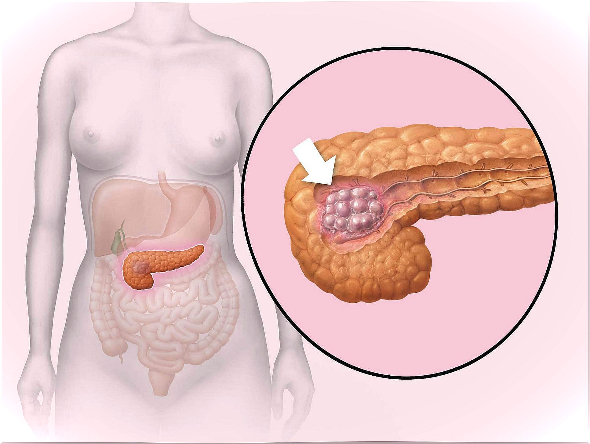 Development of pancreatic cancer.