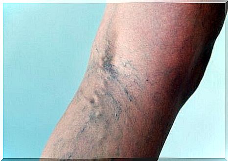 Remedies for spider veins.