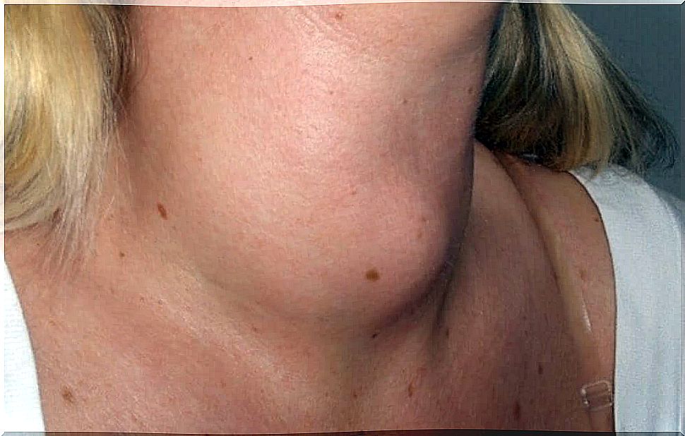 A woman with a lump in her neck