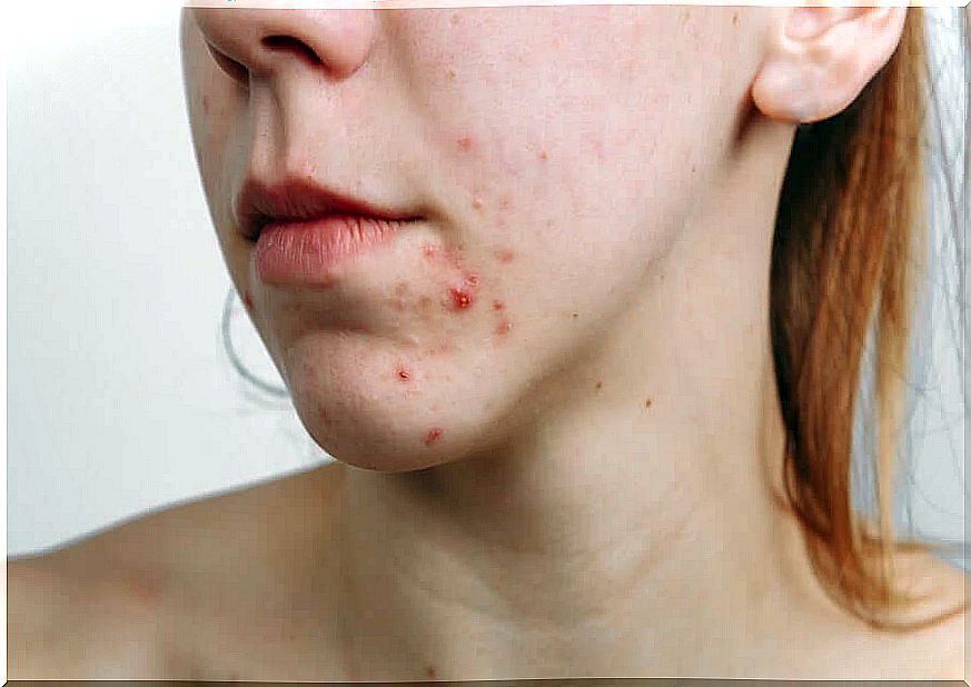 A young woman in need of acne treatment